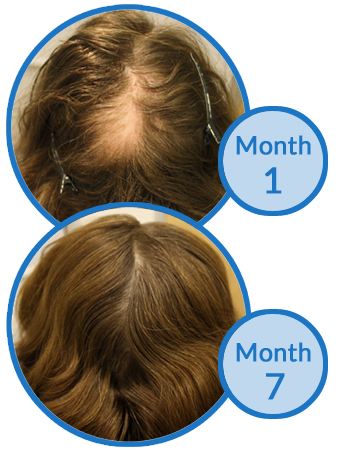 Alopecia Areata Treatment Success Story - The Belgravia Centre Hair Loss Clinic London