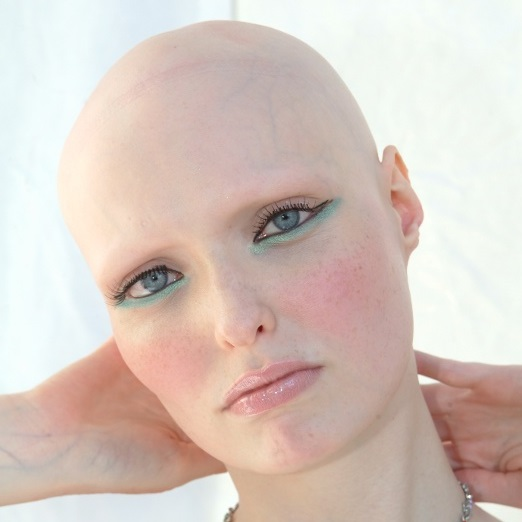 Alopecia Universalis Sufferer Brenda Finn Before Her Eyebrow Tattoos