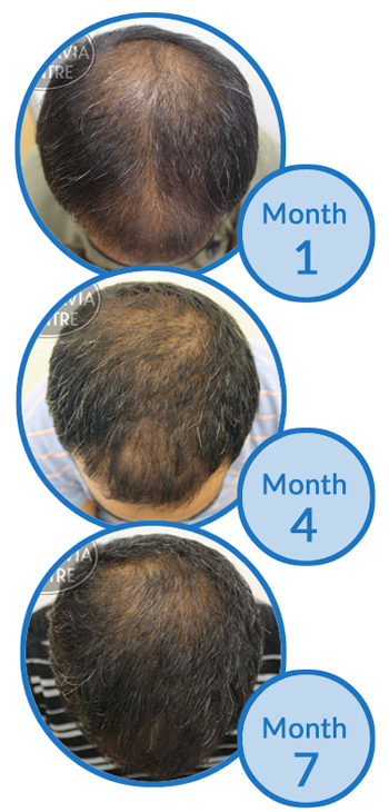 Male Hair Loss Treatment Success Story - Thinning Crown and Thinning Hair on Top
