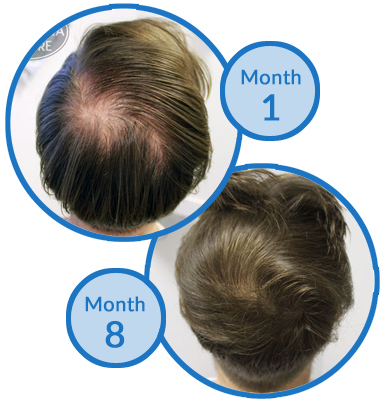 Thinning Crown Hair Loss Treatment - Belgravia Centre Client Success Story
