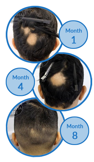 Belgravia Centre Alopecia Areata Client Treatment Success Story