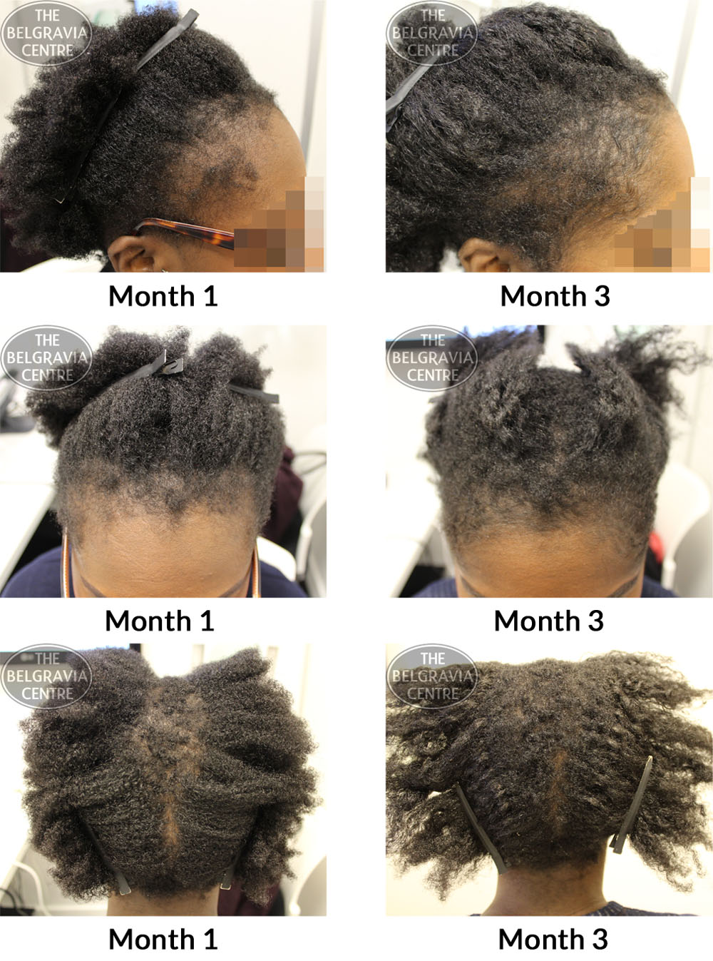 Facebook-Image-Traction-Alopecia-Female-Pattern-Hair-Loss-The-Belgravia-Centre-06-06