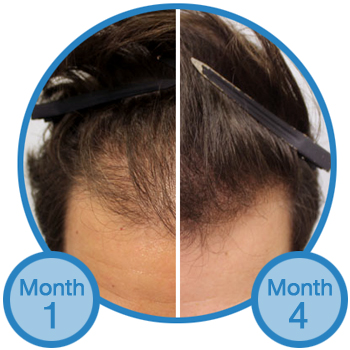 Thinning Hair Loss Treatment Success Story