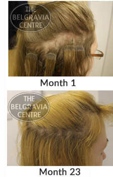 This Belgravia Client Has Seen Regrowth following Treatment for Traction Alopecia Hair Loss Caused by Hair Extensions