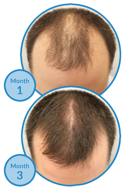 Belgravia Centre Minoxidil-Only Hair Loss Treatment Success Story