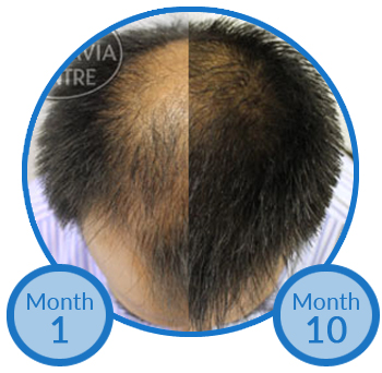 Thinning Crown and Vertex Thinning Male Pattern Hair Loss Treatment Belgravia Centre Success Story