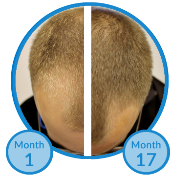 Success Story - Belgravia Centre Treatment for a Receding Hairline - Christoph