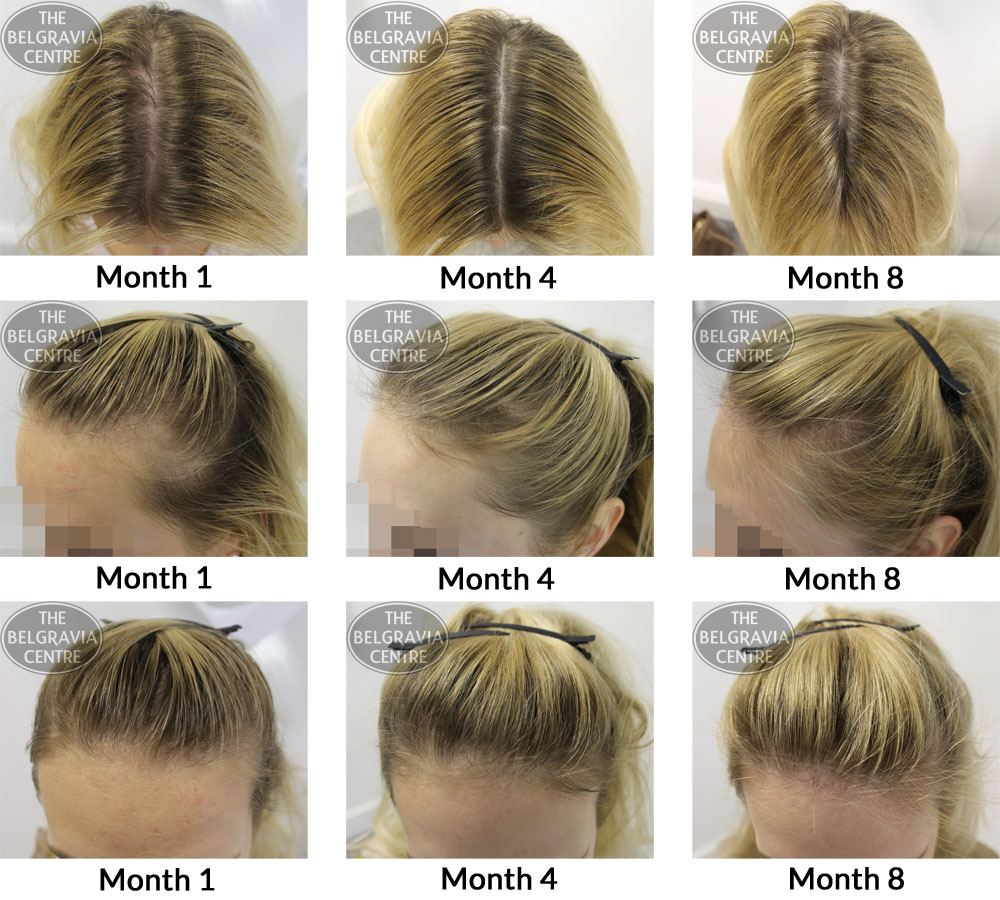 Female-Pattern-Hair-Loss-The-Belgravia-Centre-24-11