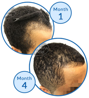 Belgravia Centre client Success Story Receding hairline male hair loss treatment thinning edges regrowth