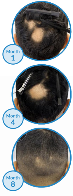 Belgravia Centre Alopecia Areata Patchy Hair Loss Treatment Success Story