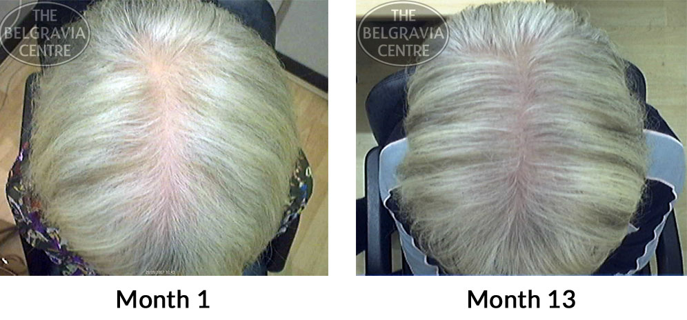 Female-Pattern-Hair-Loss-The-Belgravia-Centre-04-02