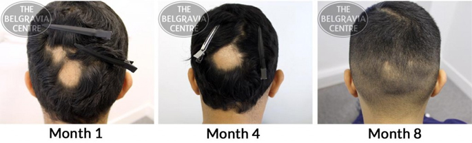 Alopecia Areata Treatment Success Story - Jagpreet