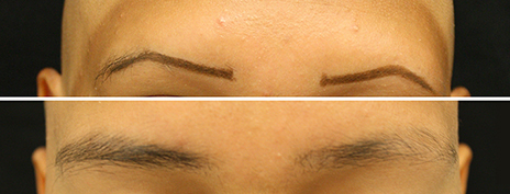 After 12 weeks of treatment at Yale, the patient had complete restoration of eyebrow hair. Yale Doctors Used Topical Ruxolitinib Cream to Regrow Hair and Eyebrows on Patient (Photos by Dr. Brett King)