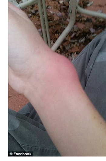 Audrey Kopp Experienced a Swollen Infected Wrist from her Hair Tie