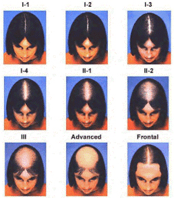 Ludwig Savin Scale of Female Pattern Hair Loss Measurement