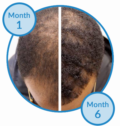 Belgravia Centre Male Pattern Hair Loss Treatment Client - Receding Hairline and Thinning Hair
