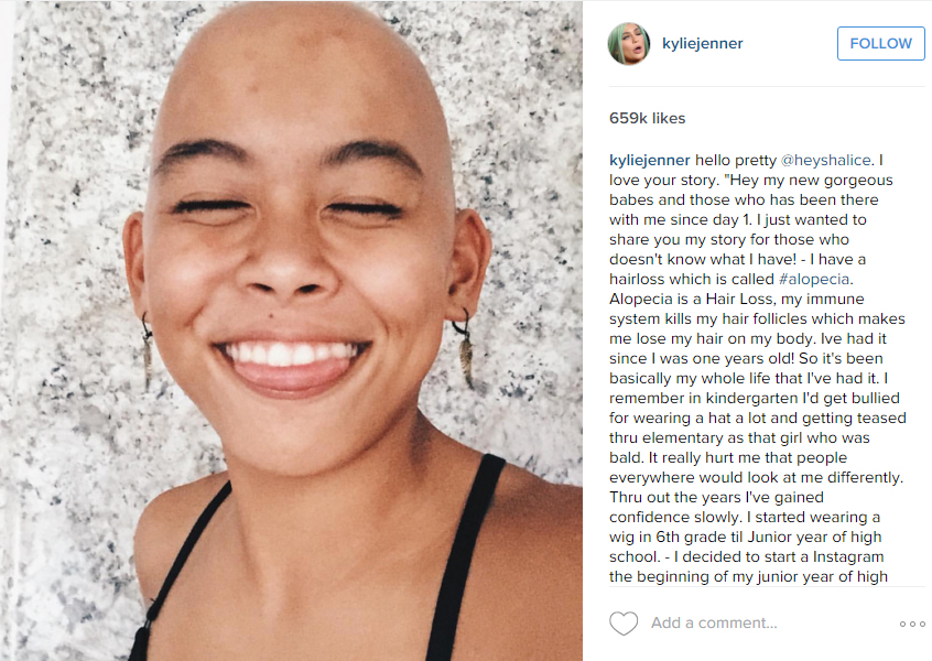 Alopecia Areata Vlogger Shalice Featured by Kylie Jenner on Instagram