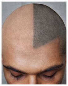 Scalp Micropigmentation - Scalp Tattoos to Disguise Hair Loss