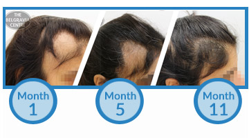 This Belgravia Alopecia Areata Client Has Seen Positive Regrowth from Treatment