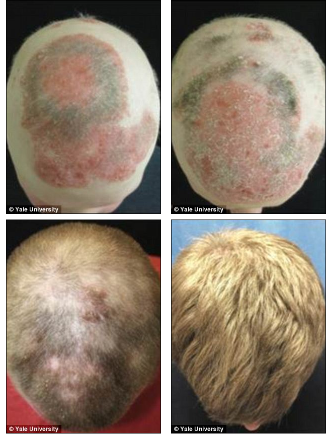  Arthritis Drug Used to Treat Hair Loss from Alopecia Universalis