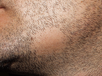 Alopecia Areata Barbae - Bald Patches in the Beard