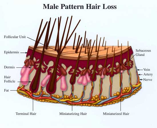 scalp miniaturisation diagram