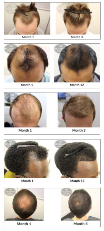 mens hair loss treatment success stories thinning hair regrowth receding hairline male pattern baldness