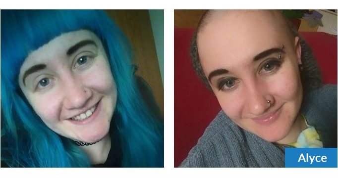 Rollergirl Alyce Shaves her head for two UK hair loss charities