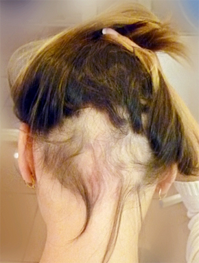 Example of Ophiasic Alopecia Hair Loss