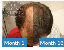 This Belgravia Centre Male Pattern Hair Loss Treatment Client Has Seen Significant Regrowth