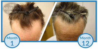 Click to View Derek's Belgravia Hair Loss Treatment Success Story