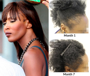 Examples of Traction Alopecia