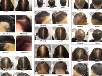 View Belgravia's Women's Hair Loss Treatment Success Stories