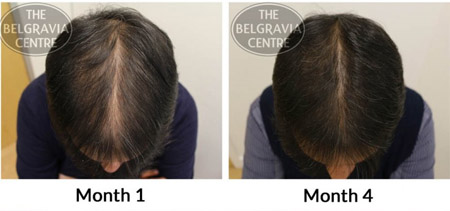 This Belgravia Client is Seeing Great Regrowth for His Thinning on Top
