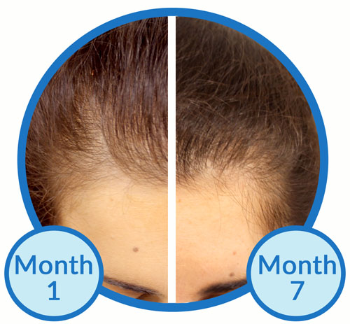 Belgravia Client Before and After Starting Treatment for Chronic Telogen Effluvium and Female Pattern Hair Loss