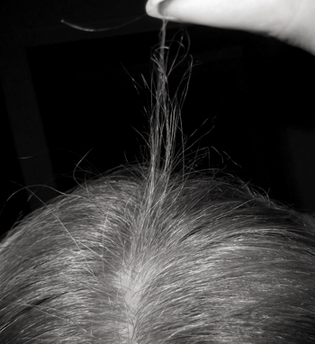 My Hair is Very Thin from Hair Breakage, Can You Help?'