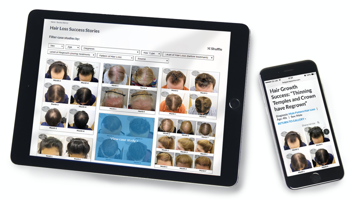 Belgravia Centre Hair Loss Clinic Launches Success Stories Before and After Photo Gallery with Results You Can Search