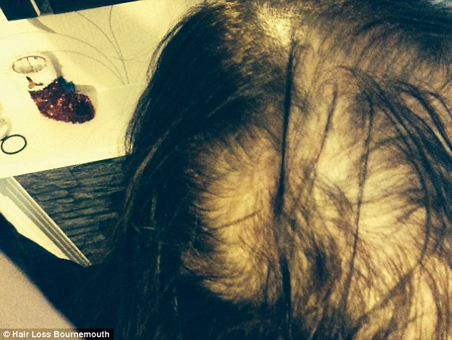 Woman's Hair Loss Attributed to Over-Dyeing on TV's 'Body Shockers'