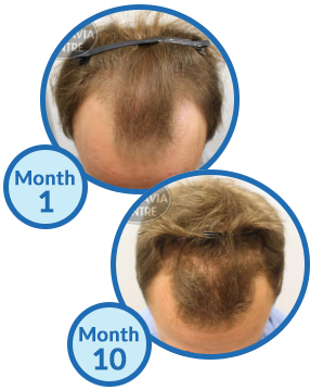 teenage male pattern hair loss treatment success story Belgravia Centre