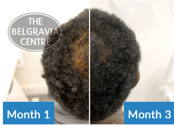 Afro Hair Male Hair Loss Treatment Success Story - Thinning Crown