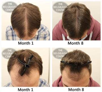 Belgravia Male Pattern Hair Loss Treatment Client Notices Dramatically Thicker Hair After 8 Months
