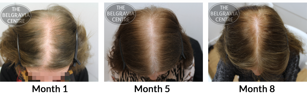 Belgravia Client Amal Has Seen Significant Regrowth from her Treatment for Female Pattern Hair Loss and Chronic Telogen Effluvium