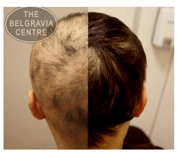 Alopecia Areata Client Successfully Treated By The Belgravia Centre Hair Loss Clinic