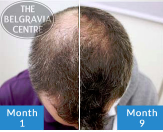Click to See Belgravia Client Scott's Male Pattern Baldness Hair Loss Treatment Success Story