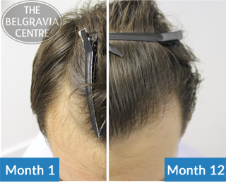 This Belgravia Client Is Using Our Male Hair Loss Treatments to Restore His Receding Hairline