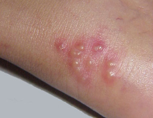 Examples of vesicles on the skin