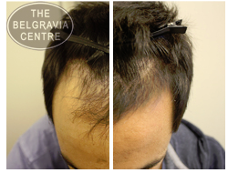 Belgravia Centre Male Hair Loss Client Impressed With Confidence Boost From Regrowth