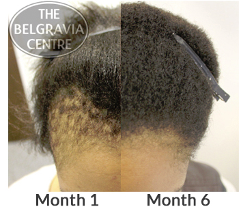 Belgravia Centre Treatment For Traction Alopecia - Example of Client Regrowth