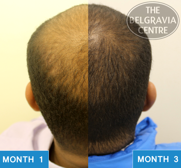 Regrowth Results From Belgravia Centre Hair Loss Treatment Course - Months 1 to 3 - 2015