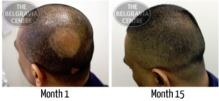 Mr H before and after Belgravia Centre treatment for Alopecia Areata